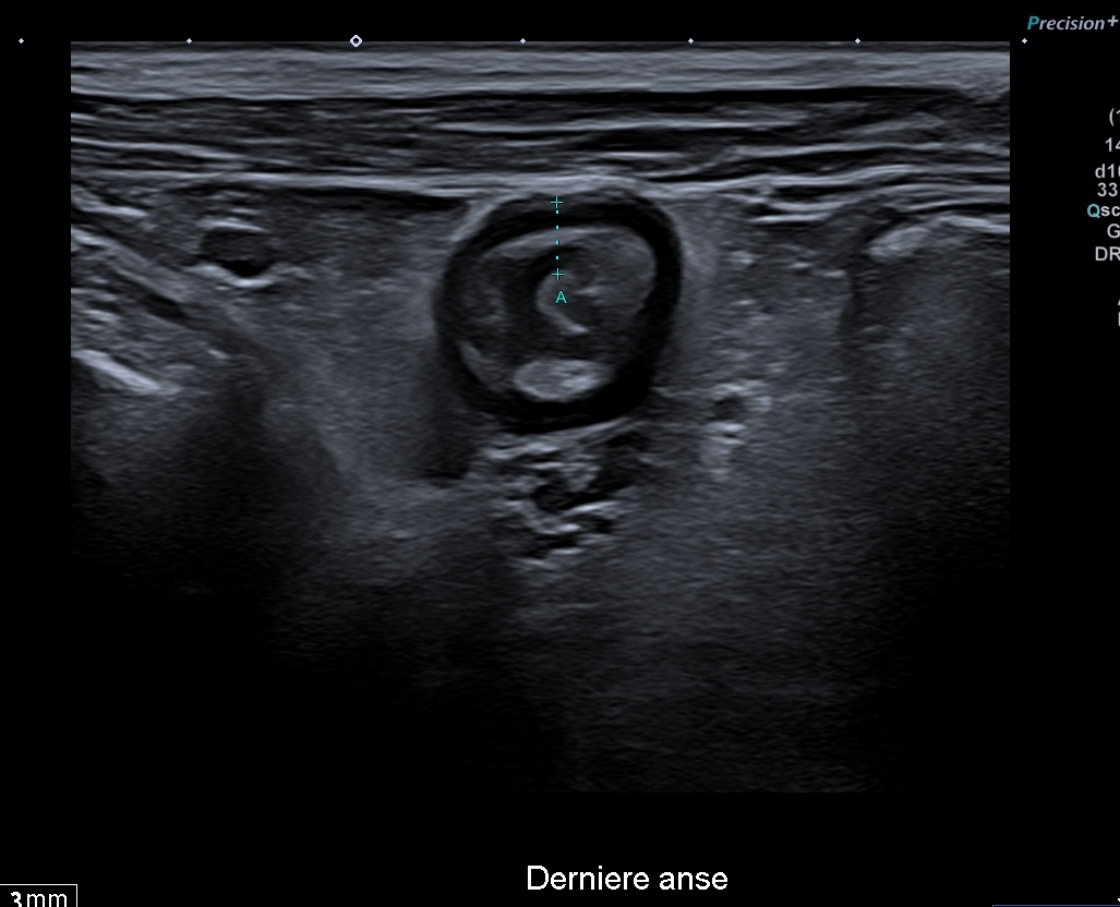 iléon transverse