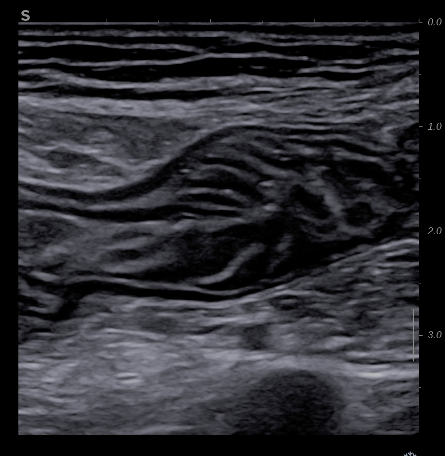 Jéjunum aspect feuilleté typique