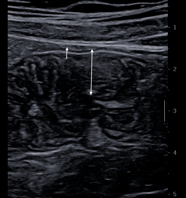 jejunum