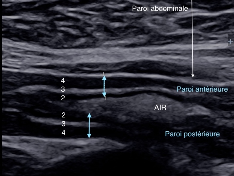 double paroi antre gastrique en échographie.jpg