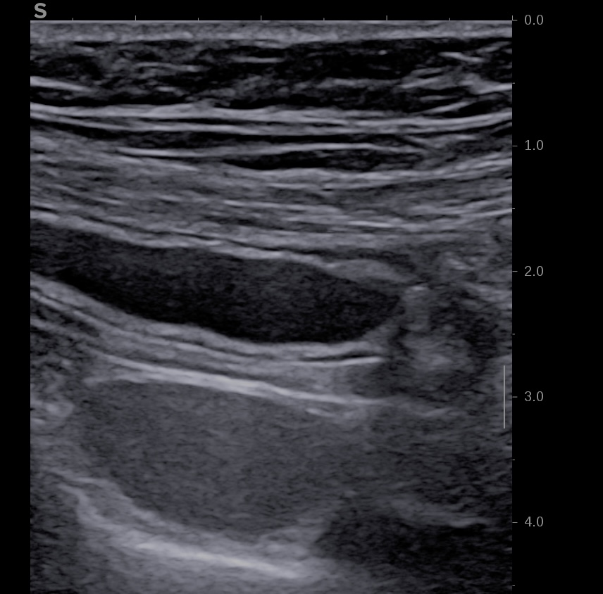 Corps de l'appendice distendu