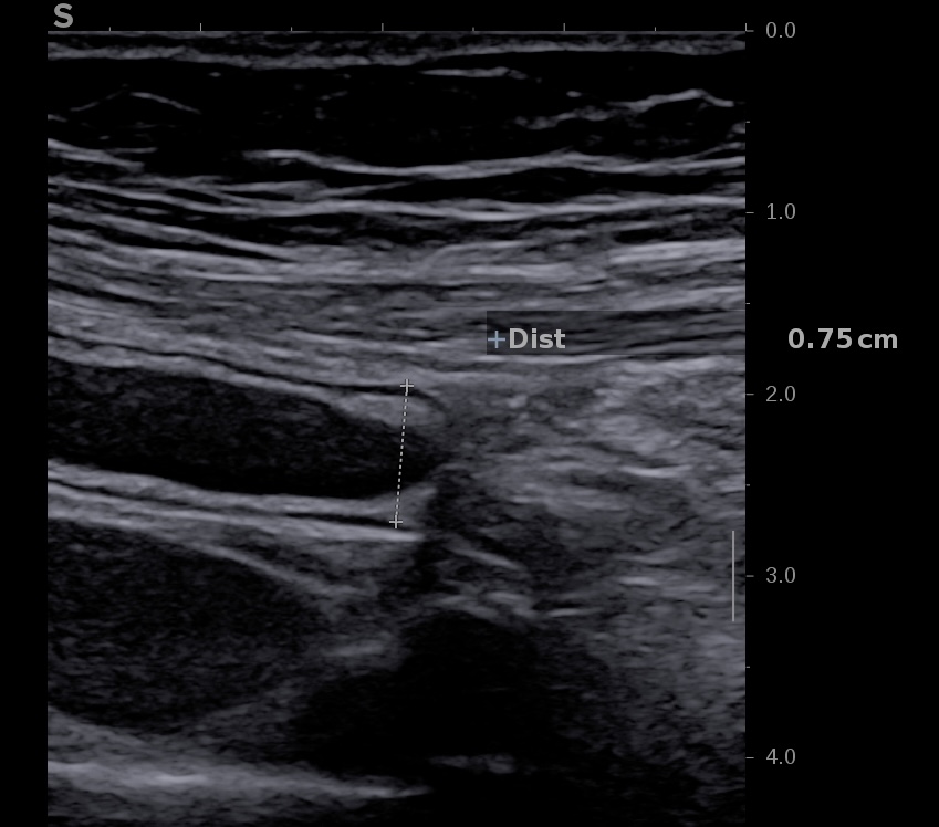 Pointe de l'appendice