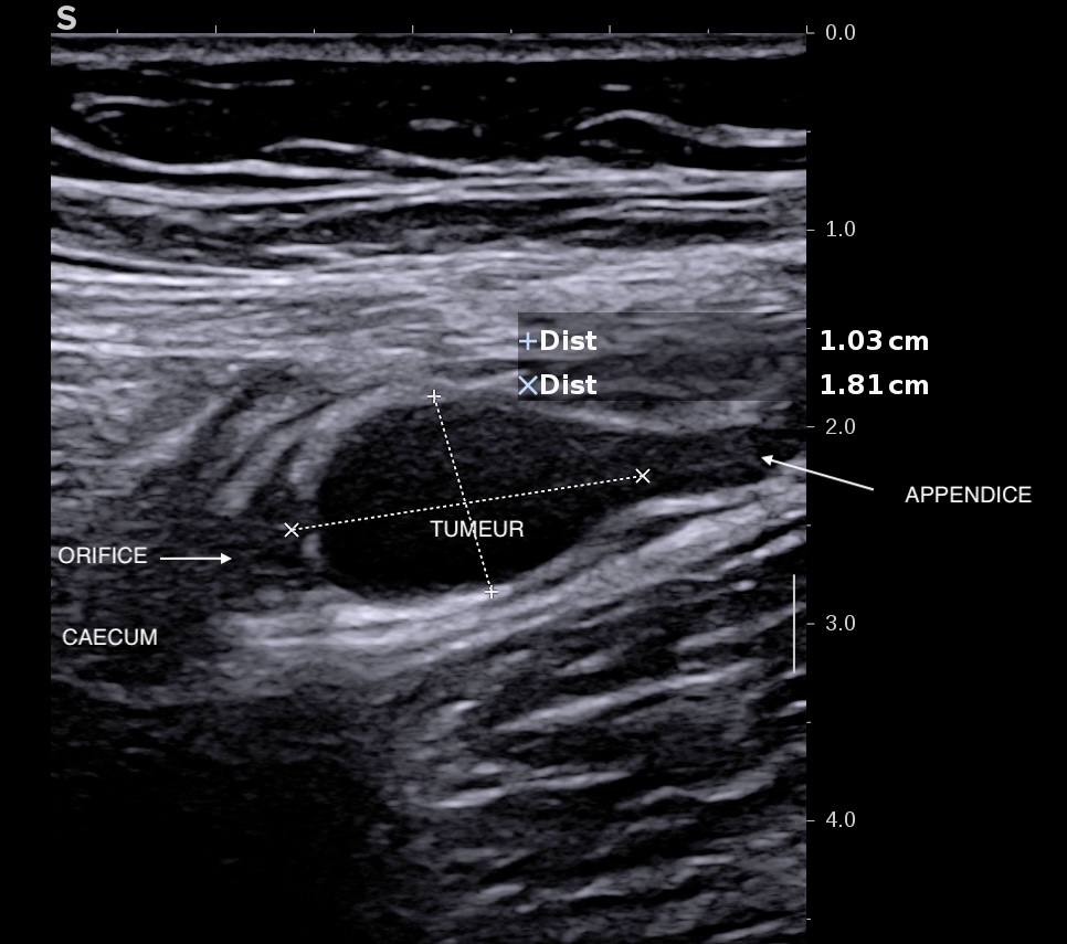Tumeur dans l'orifice appendiculaire en coupe