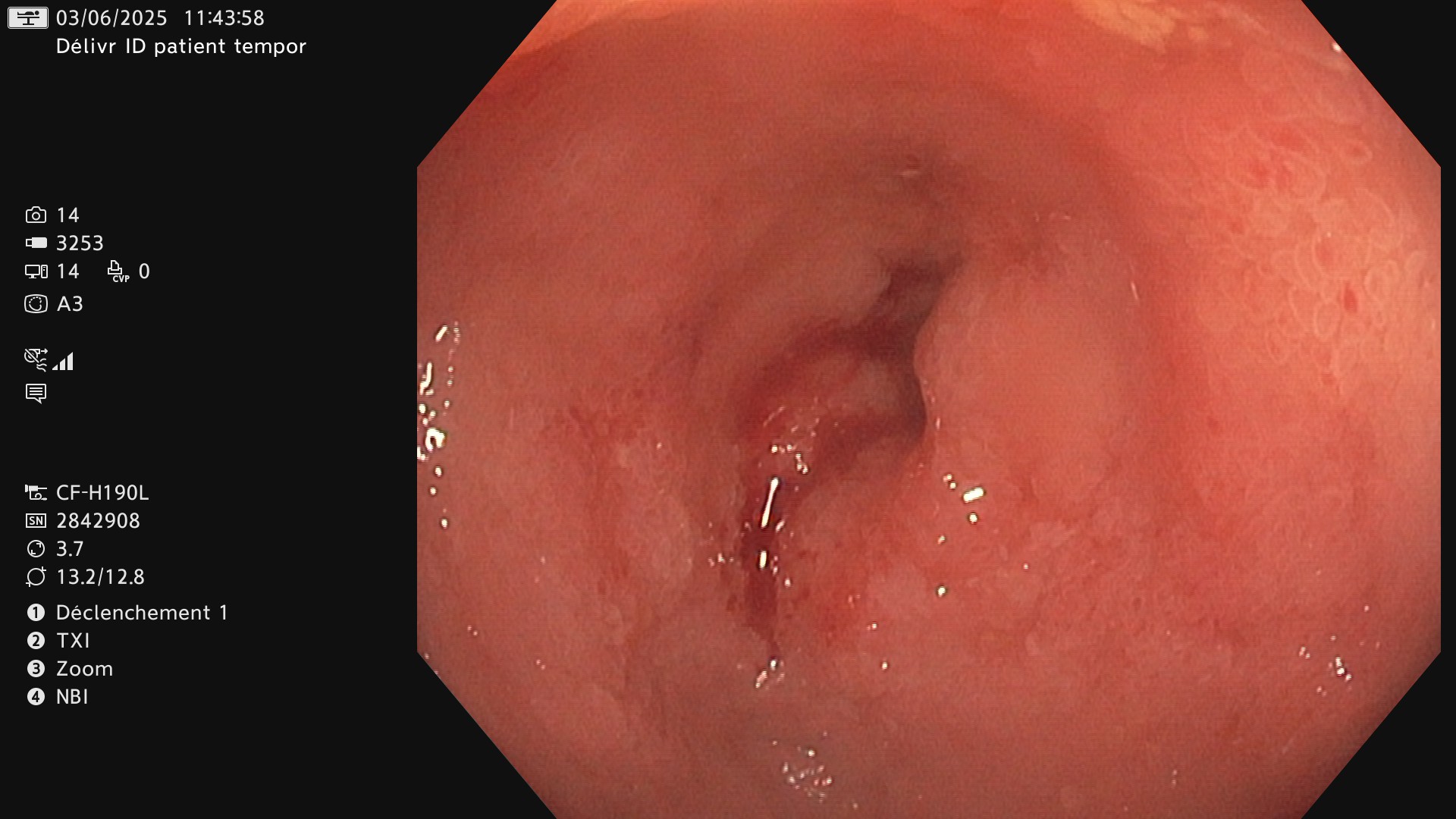 Endoscopie lésions iléales non creusantes