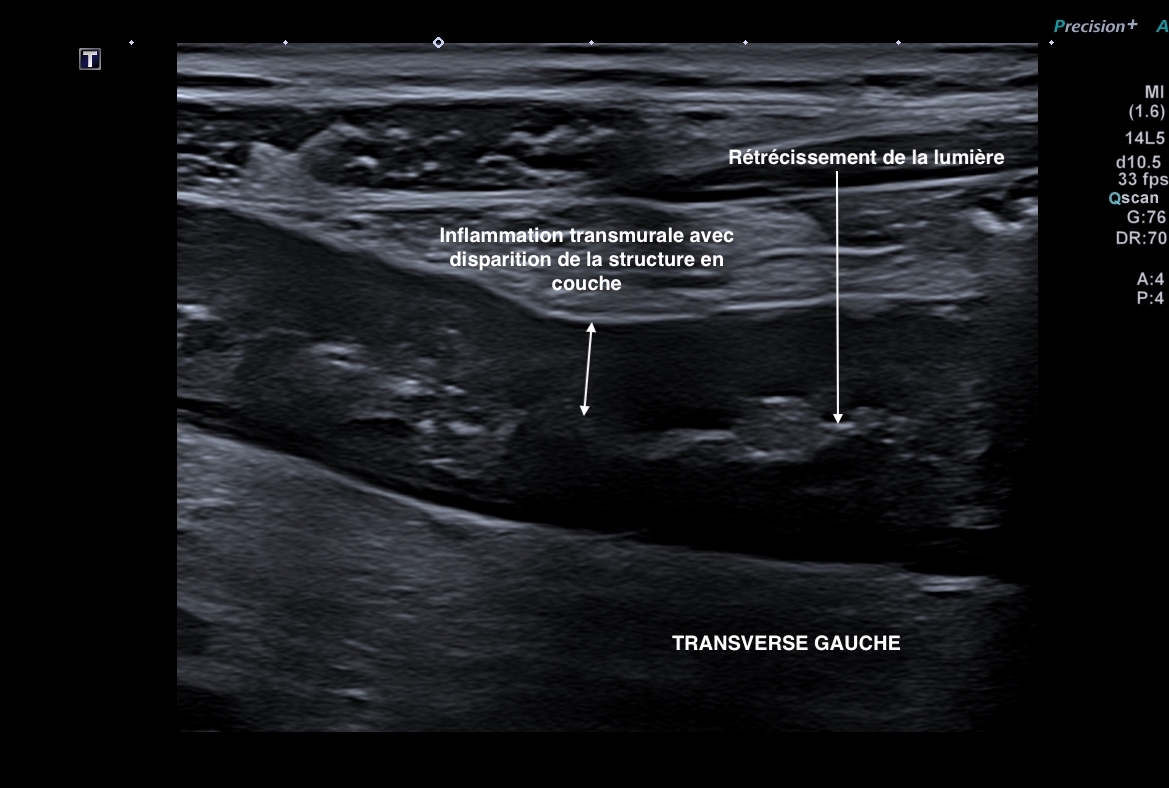 transverse gauche