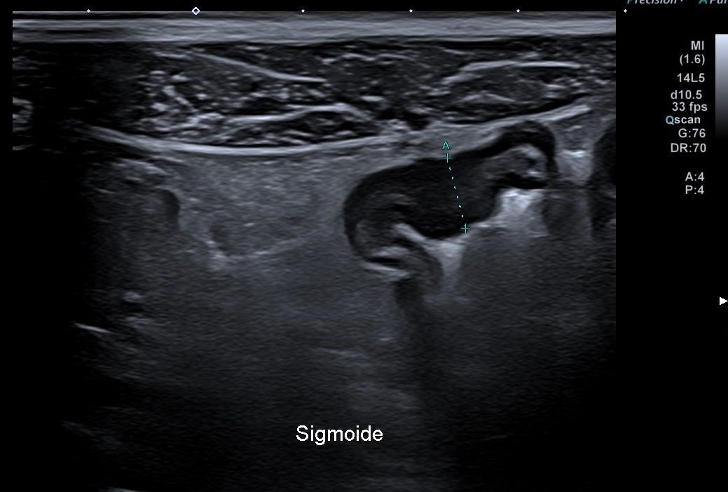 Sigmoide: inflammation transmurale focale