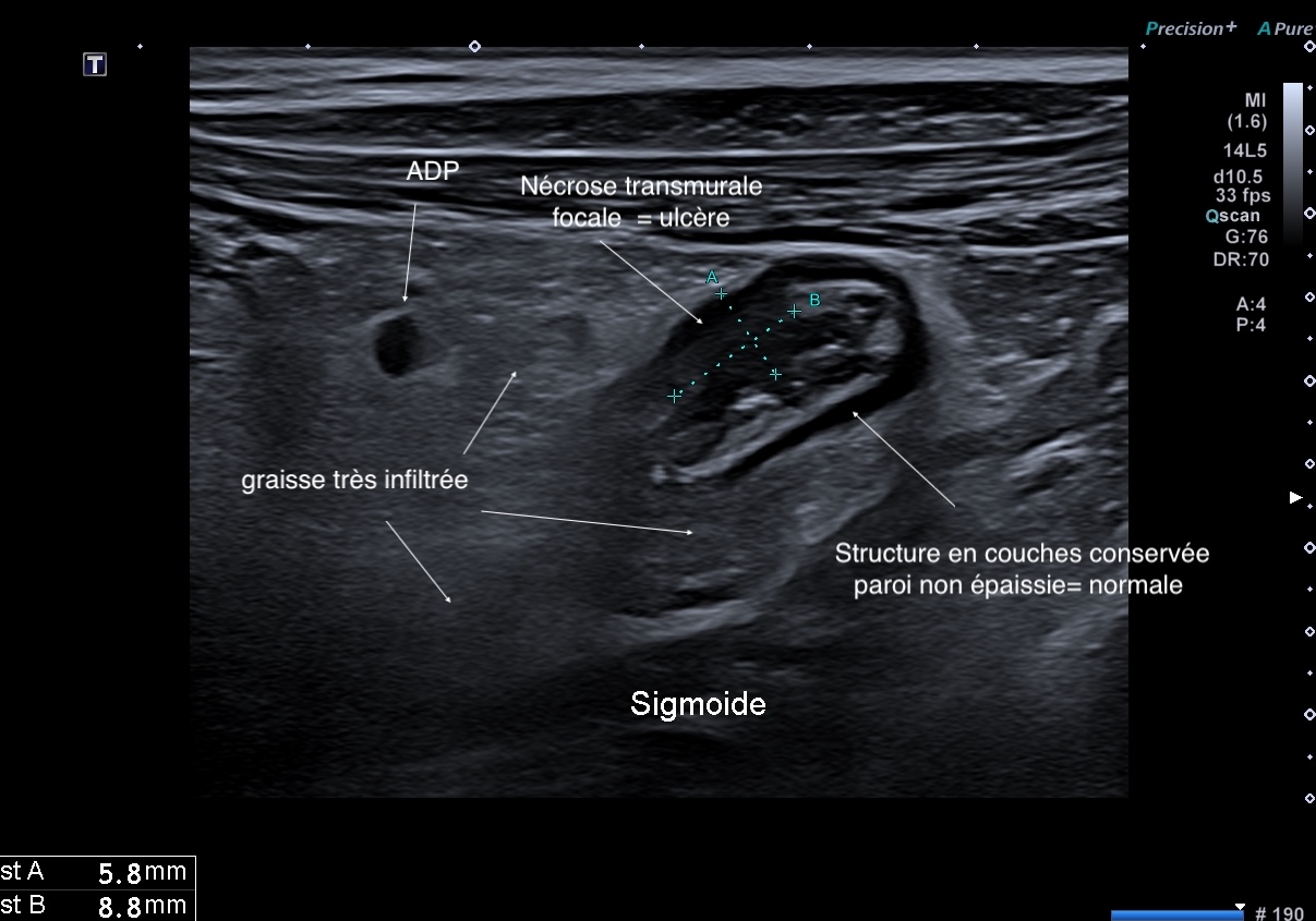 Transmural focal, graisse, ganglion