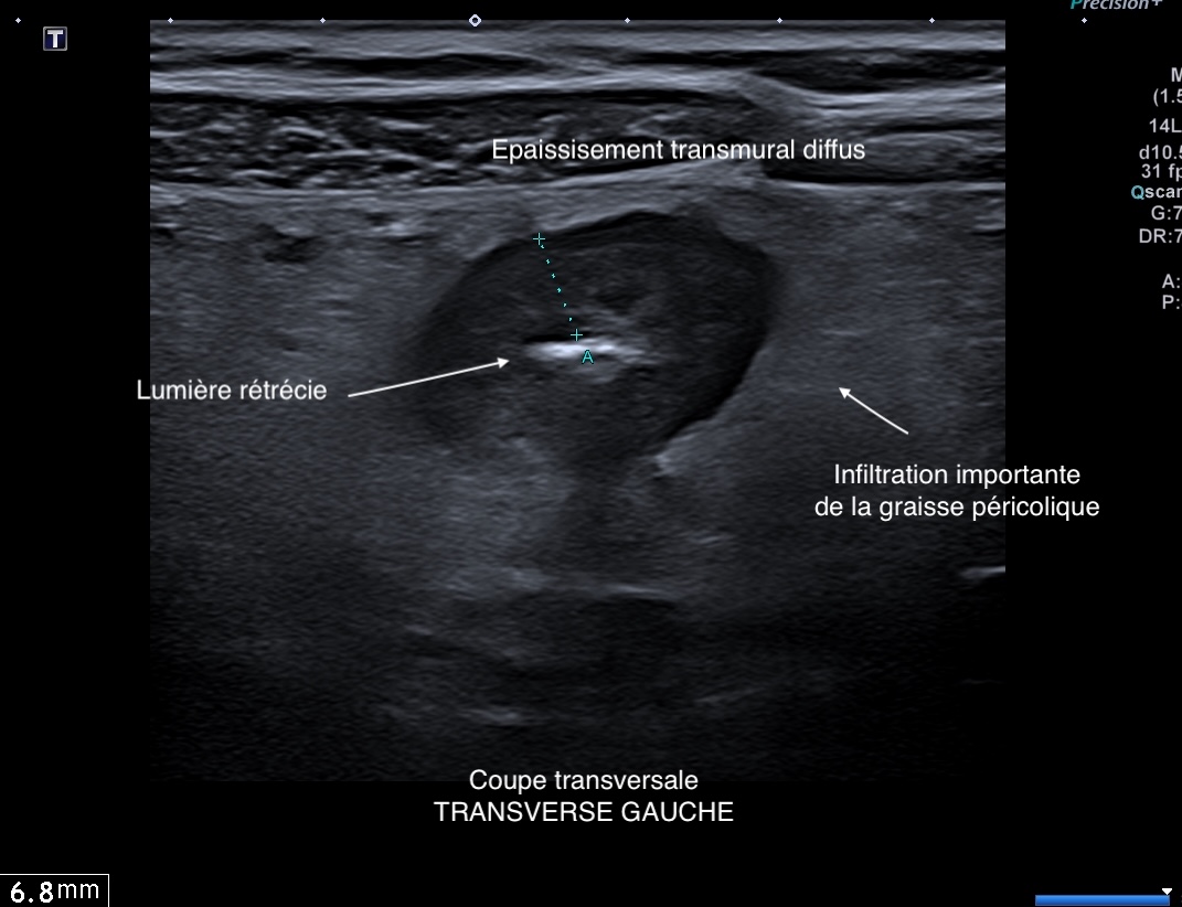 transverse gauche