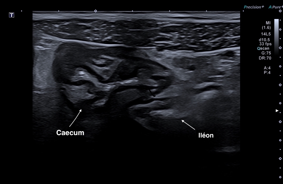 Caecum