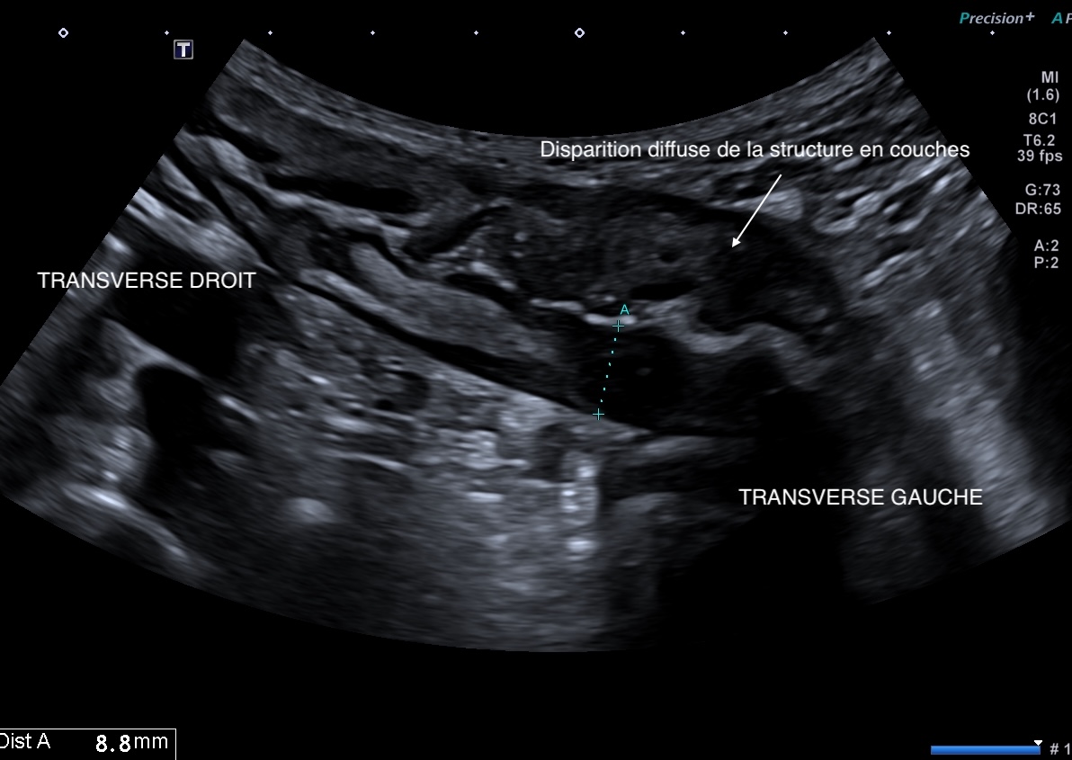 transverse droit et gauche