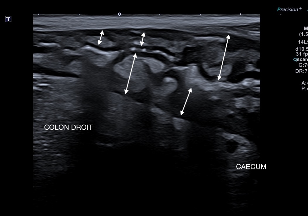 Colon droit coupe longitudinale