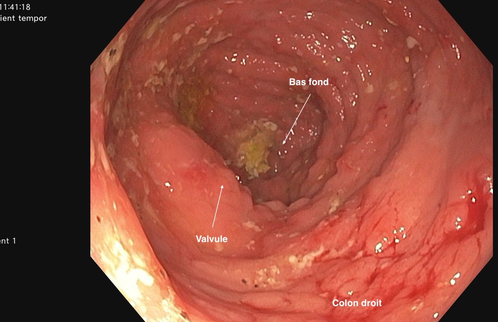 Colon droit vu de l'angle droit