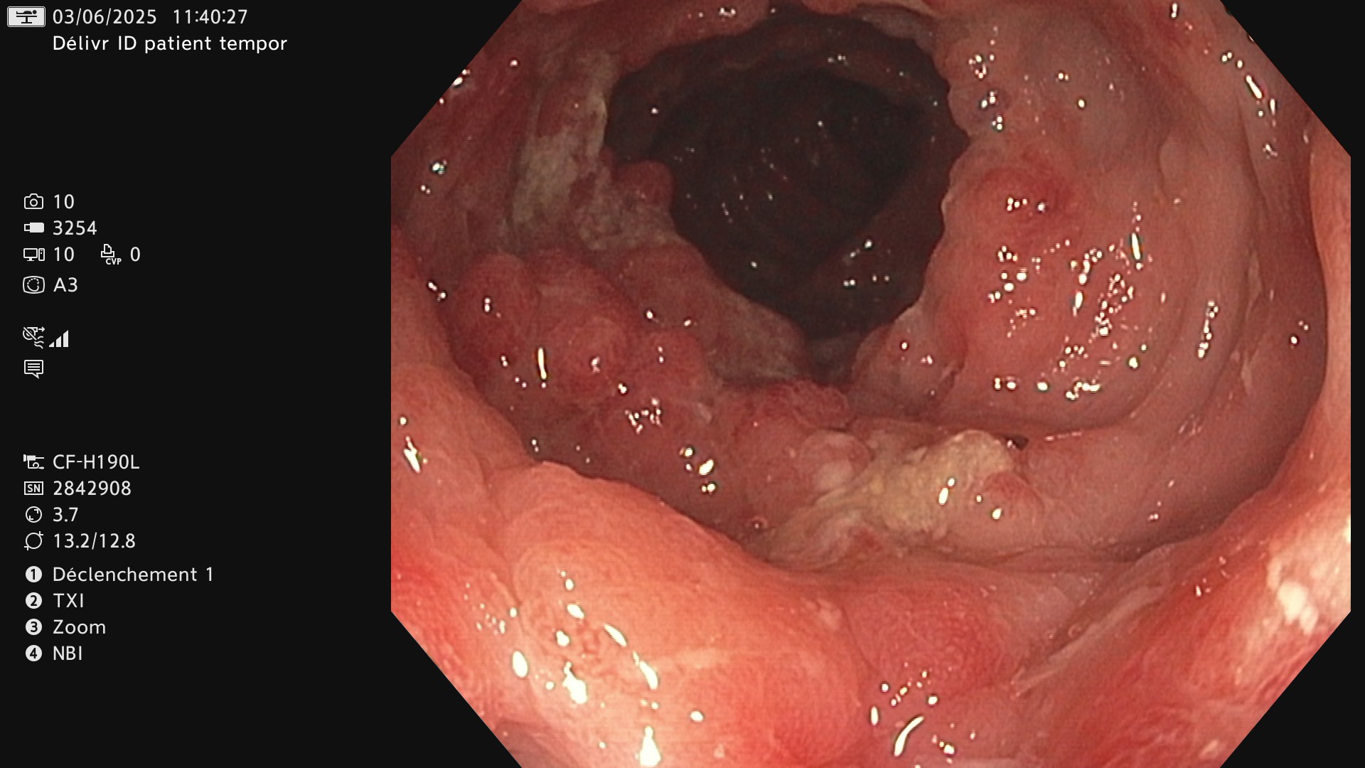 Ulceration colique creusante